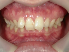 矯正歯科　治療前