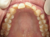 矯正歯科　治療前　上顎