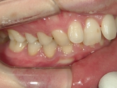 矯正歯科　治療前　右