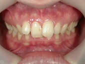 矯正歯科　治療前　正面