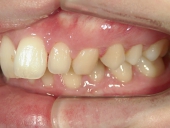 矯正歯科　治療前　左