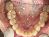 矯正歯科　治療前　下顎