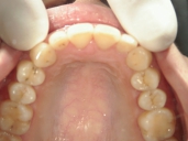 矯正歯科　治療後　上顎