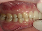 矯正歯科　治療後　右