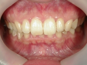 矯正歯科　治療後　正面