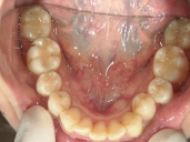 矯正歯科　治療後　下顎