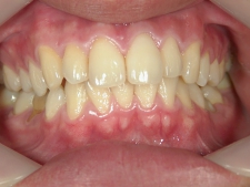 矯正歯科　アクアシステム（透明マウスピース矯正）　治療後