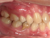 矯正歯科　治療前　右