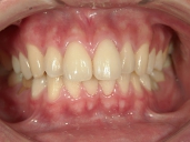 矯正歯科　治療前　正面