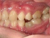 矯正歯科　治療前　左