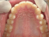 矯正歯科　治療後　上顎