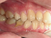 矯正歯科　治療後　右