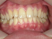 矯正歯科　治療後　正面