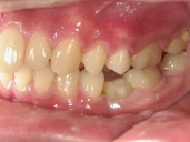 矯正歯科　治療後　左