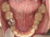 矯正歯科　治療後　下顎