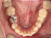 矯正歯科　治療前　下顎