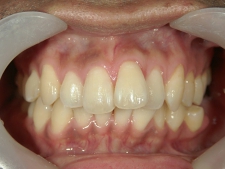 矯正歯科　治療前