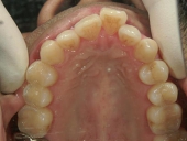 矯正歯科　治療前　上顎