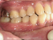 矯正歯科　治療前　右