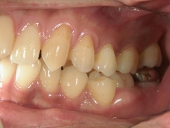 矯正歯科　治療前　左