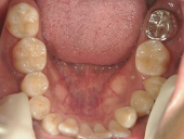 矯正歯科　治療前　下顎