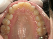 矯正歯科　治療後　上顎