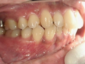 矯正歯科　治療後　右