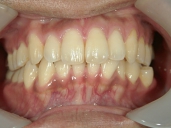 矯正歯科　治療後　正面