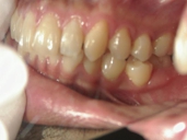 矯正歯科　治療後　左