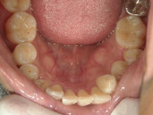 矯正歯科　治療後　下顎