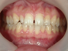 矯正歯科　治療前