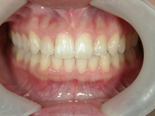 矯正歯科　アクアシステム（透明マウスピース矯正）　治療後