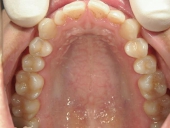 矯正歯科　治療前　上顎