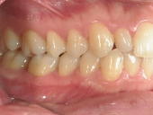 矯正歯科　治療前　右