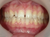 矯正歯科　治療前　正面