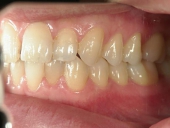 矯正歯科　治療前　左