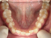 矯正歯科　治療前　下顎
