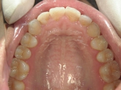 矯正歯科　治療後　上顎