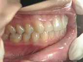 矯正歯科　治療後　右