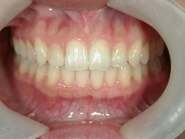 矯正歯科　治療後　正面