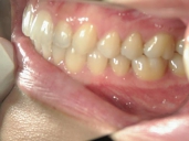 矯正歯科　治療後　左