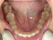 矯正歯科　治療後　下顎