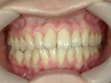 矯正歯科　治療前