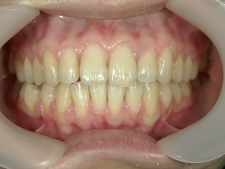 矯正歯科　アクアシステム（透明マウスピース矯正）　治療後