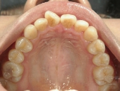 矯正歯科　治療前　上顎