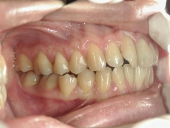 矯正歯科　治療前　右