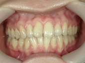 矯正歯科　治療前　正面
