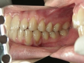 矯正歯科　治療前　左