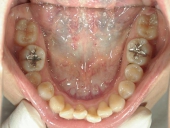 矯正歯科　治療前　下顎