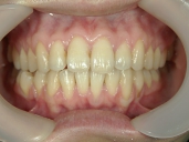 矯正歯科　治療後　正面